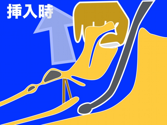 TEE挿入直後視界upload.001.jpg