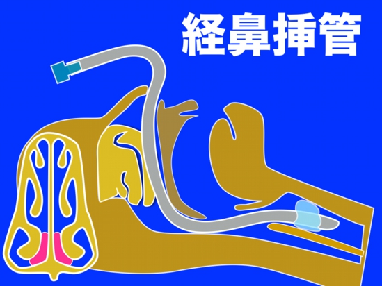 経鼻挿管局麻001.jpg